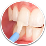 Фторирование зубов после чистки