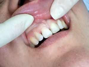 Зубы после лечения