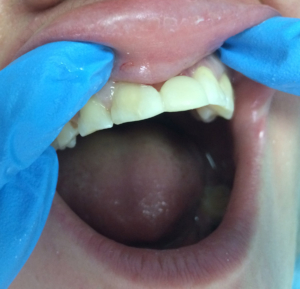 Произведено временное восстановление зубного ряда в области 21 зуба с помощью Гласспана и композитного материала, до установления импланта и коронки.