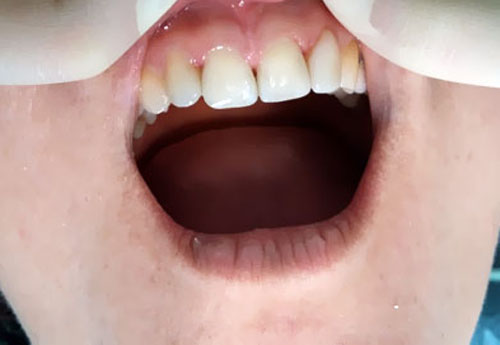 Зуб после лечения