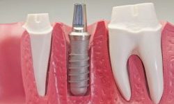Протезирование или имплантация зубов